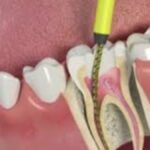 Root of the Problem: Uncovering the Causes of Dental Abscesses