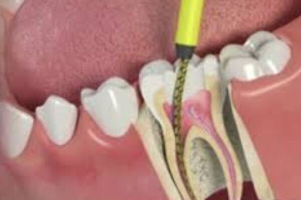 Root of the Problem: Uncovering the Causes of Dental Abscesses