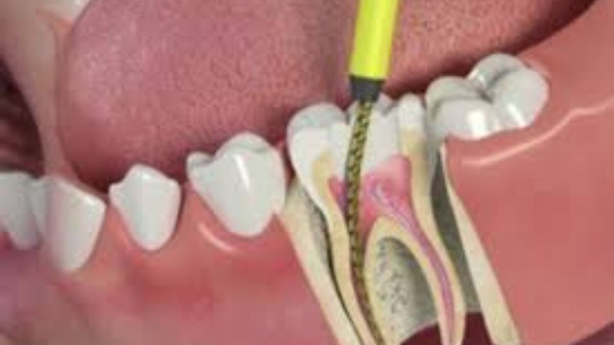 Root of the Problem: Uncovering the Causes of Dental Abscesses